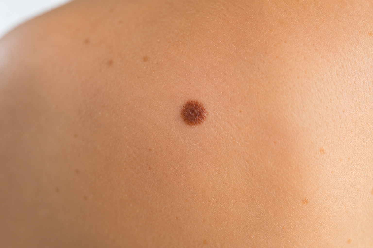 Mole mapping and skin analysis — early detection